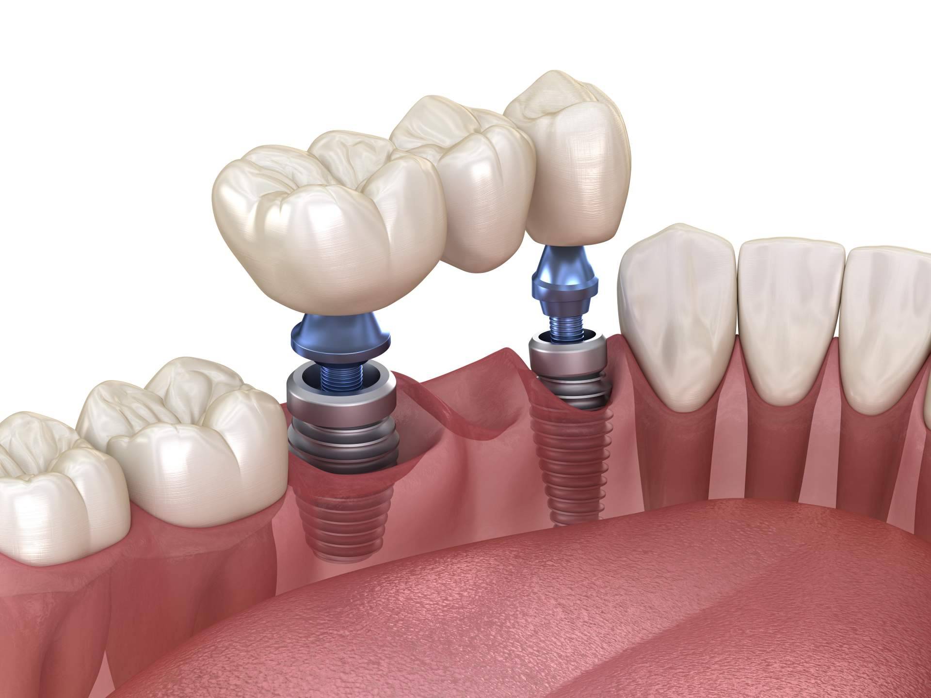 El tratamiento de implante dental de titanio en Sevilla realizado por Clínica Dental Helident