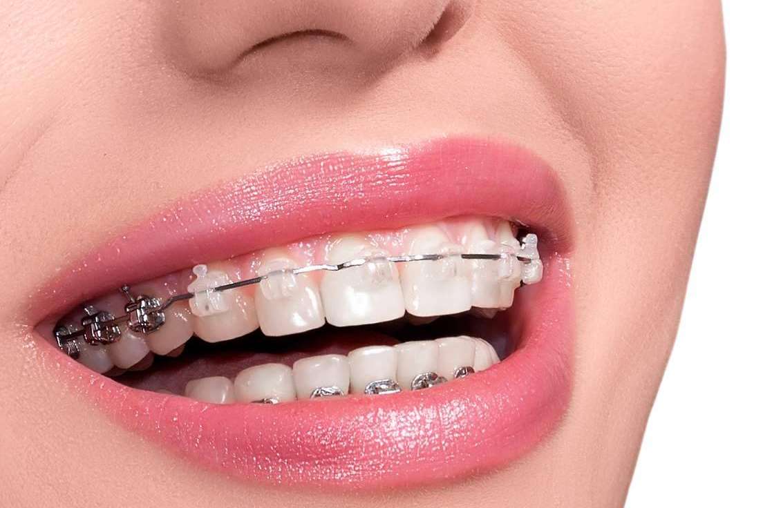Tratamiento de ortodoncia con brackets en Helident Clínica Dental