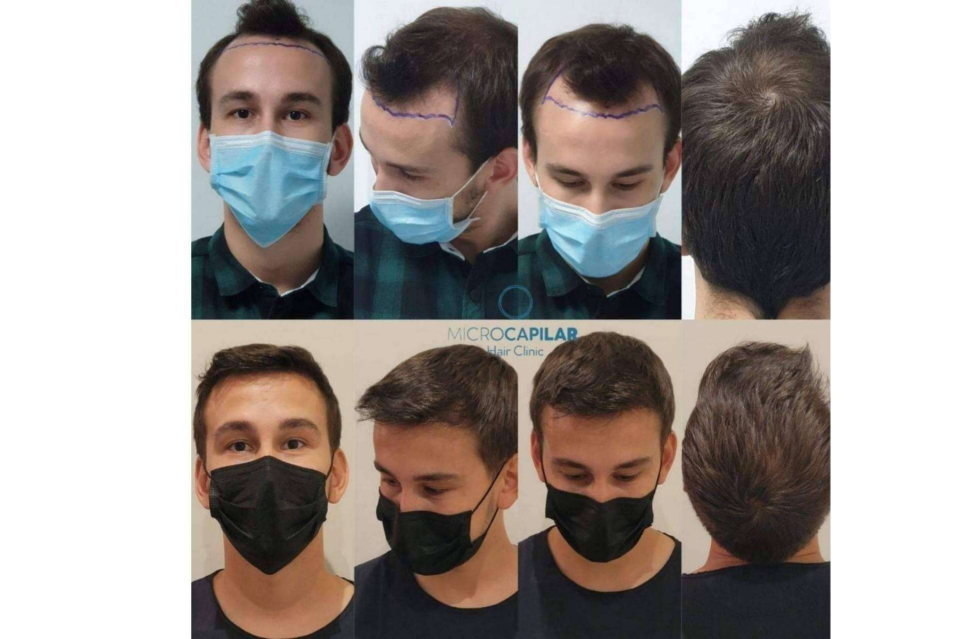 ¿Cuáles son las ventajas de realizar un injerto capilar en España con el servicio de Microcapilar Hair Clinic?