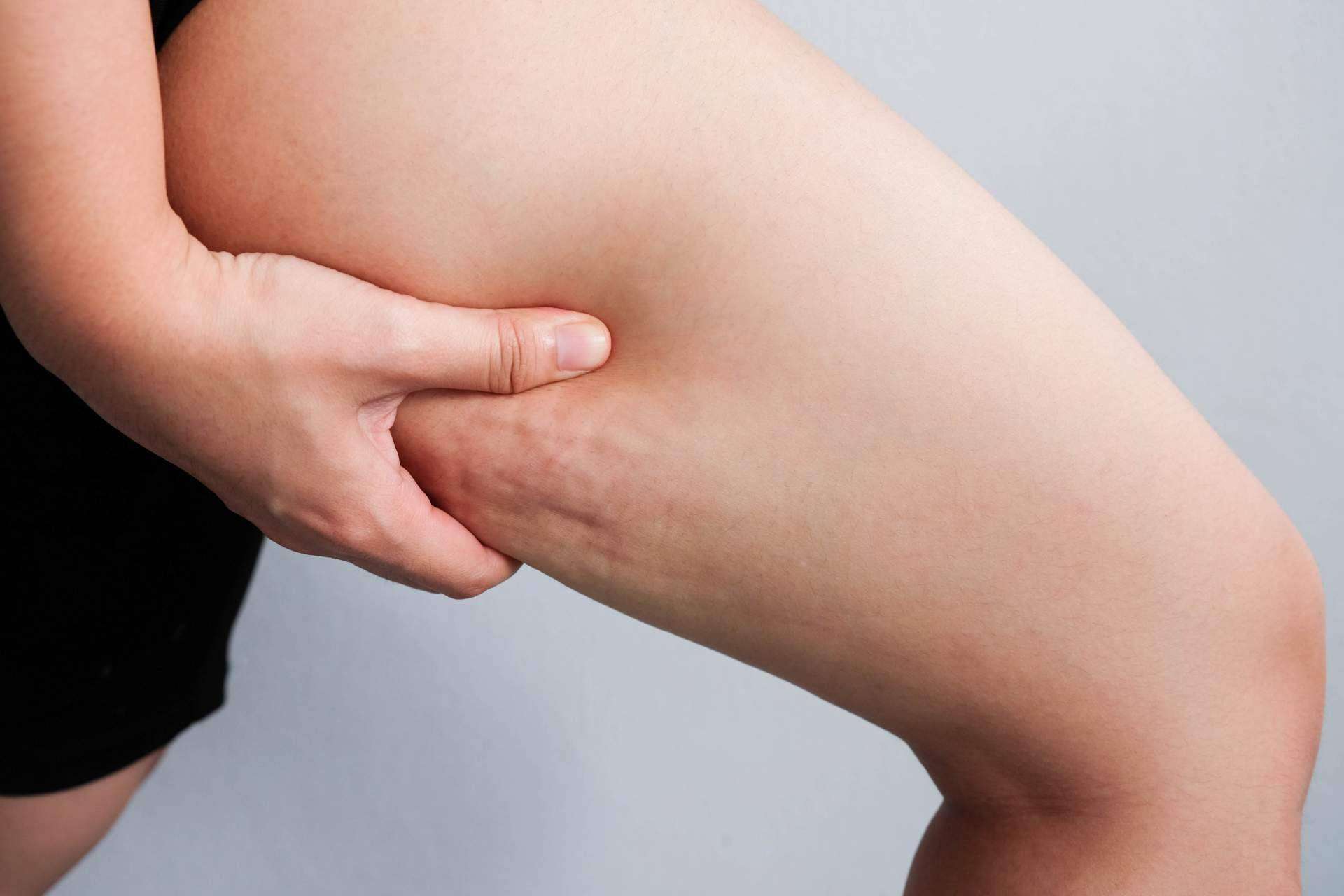 Sincelut Forte ayuda a combatir la celulitis de forma natural