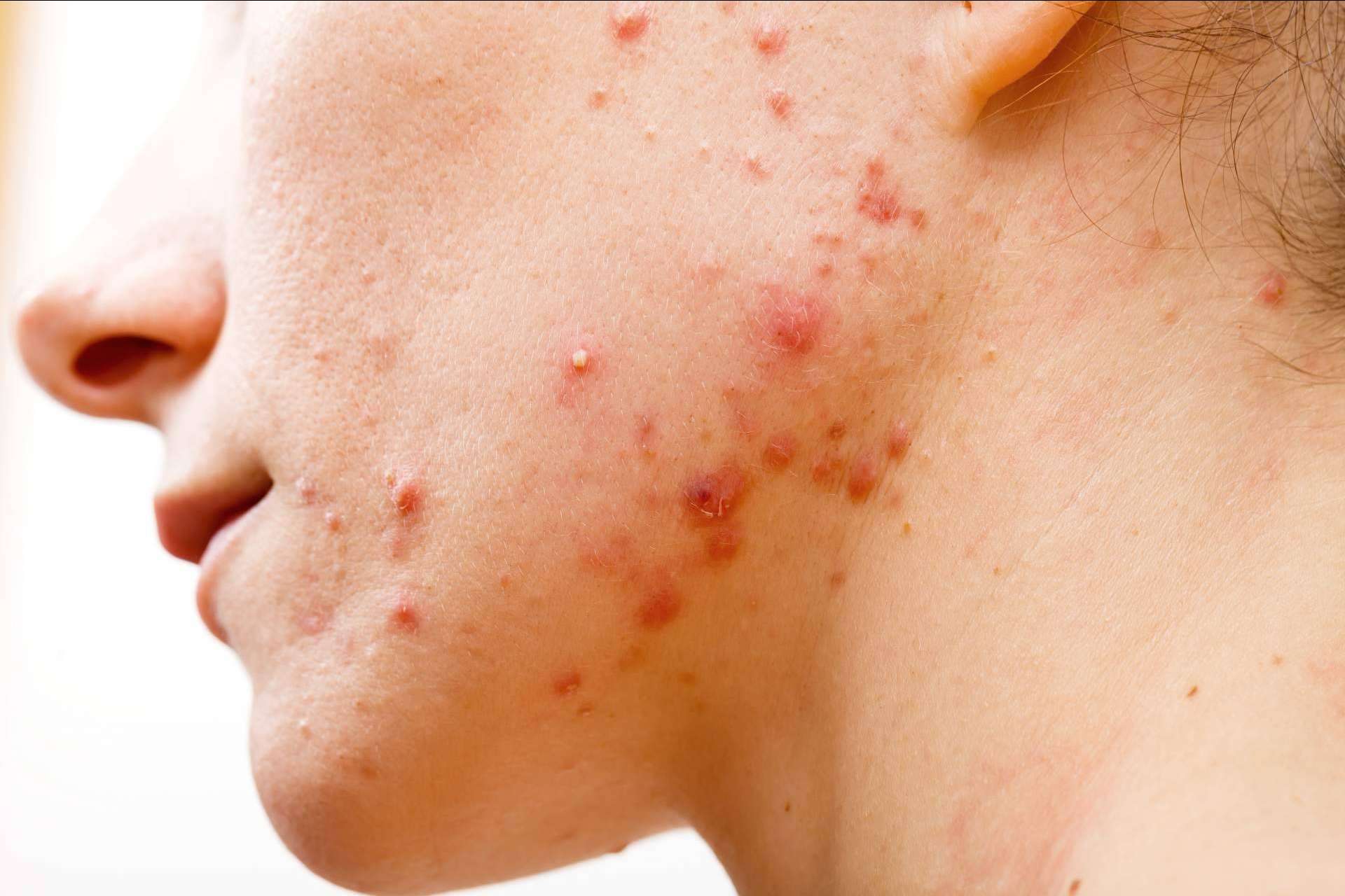 AcnéXero, la aplicación fundada por dermatólogos que propone soluciones efectivas para combatir el acné