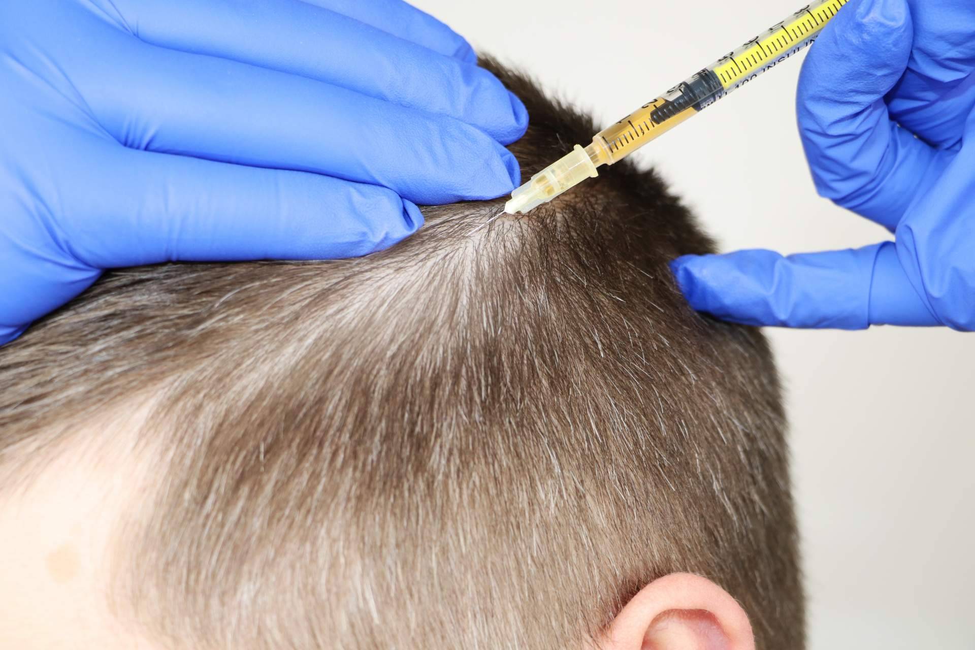 ¿Cuáles son las ventajas de la mesoterapia capilar que realiza el Dr. Bruno Jacobovski?