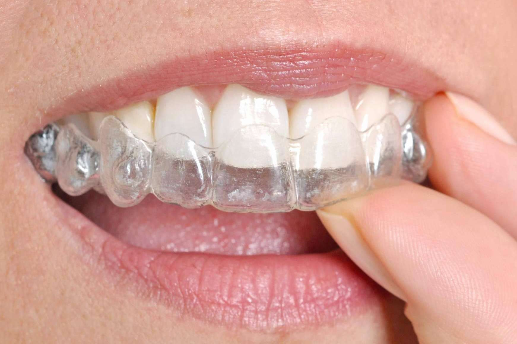 Los centros recomendados con el Certificado de Calidad DentalQuality® cuentan con servicios de ortodoncia invisible