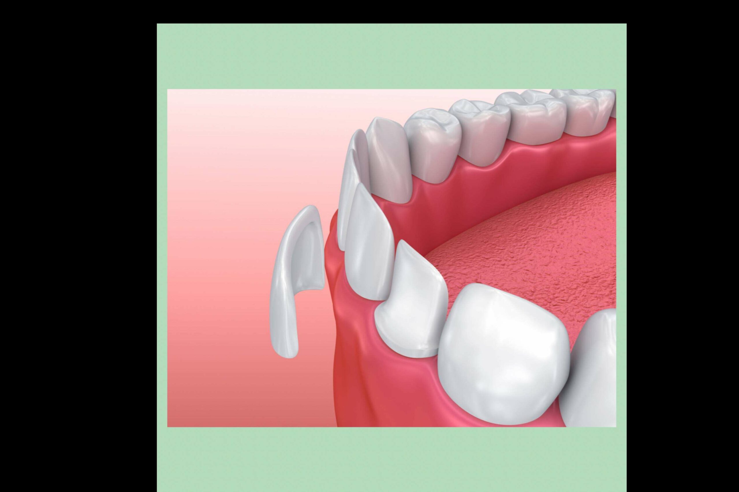 La aplicación de carillas dentales en la Clínica Paula Vidal