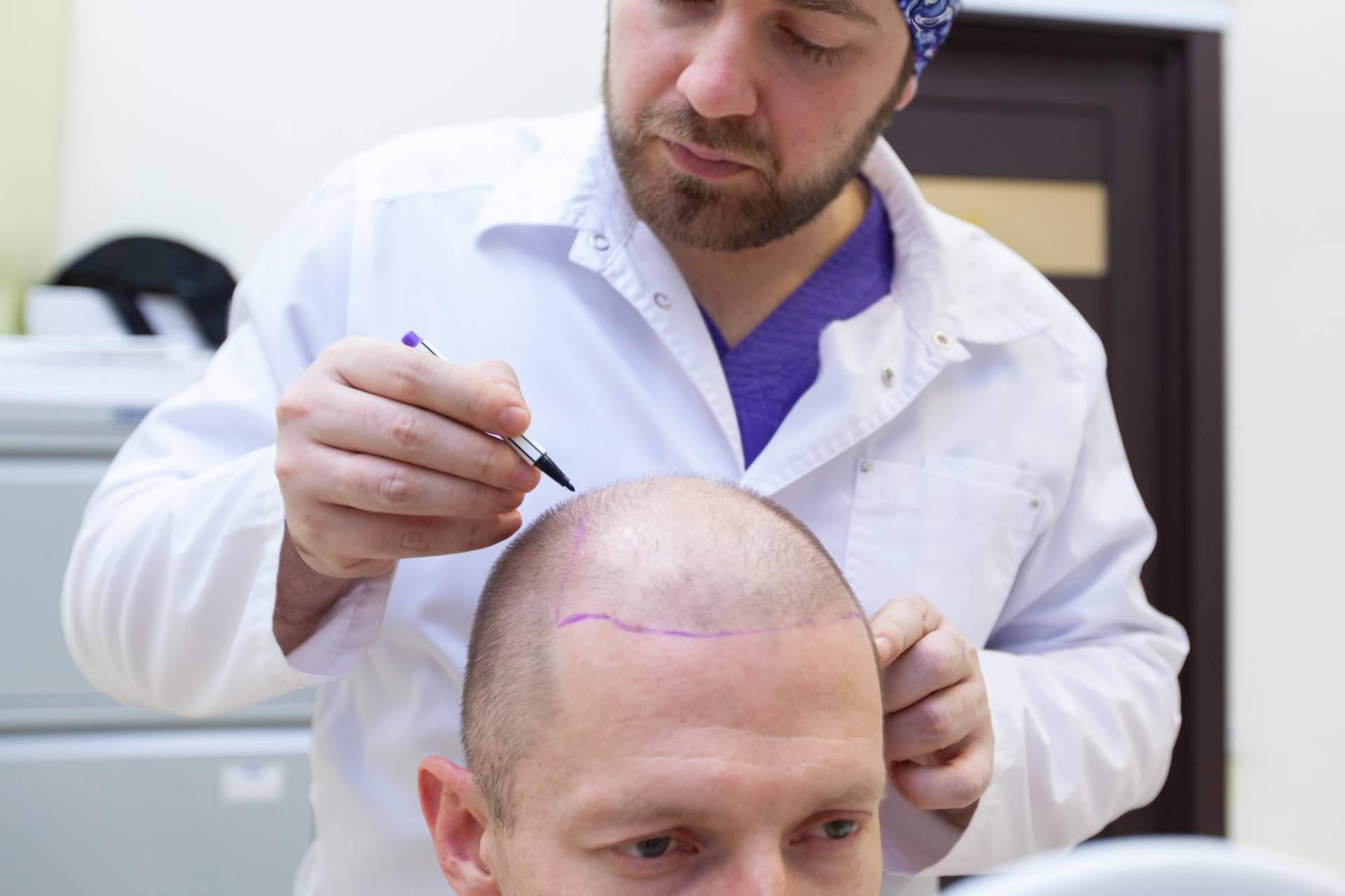Cómo ha evolucionado el injerto capilar en España y Europa gracias a la intervención de clínicas como Clínicas Be
