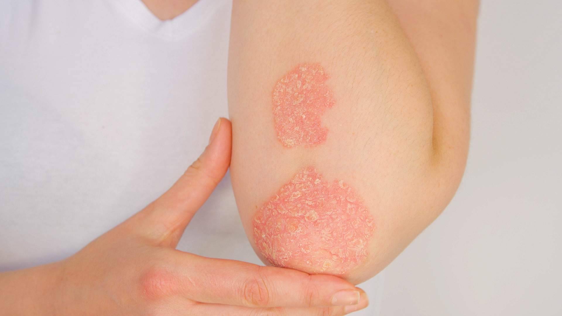 El tratamiento efectivo para la psoriasis de Soriasel