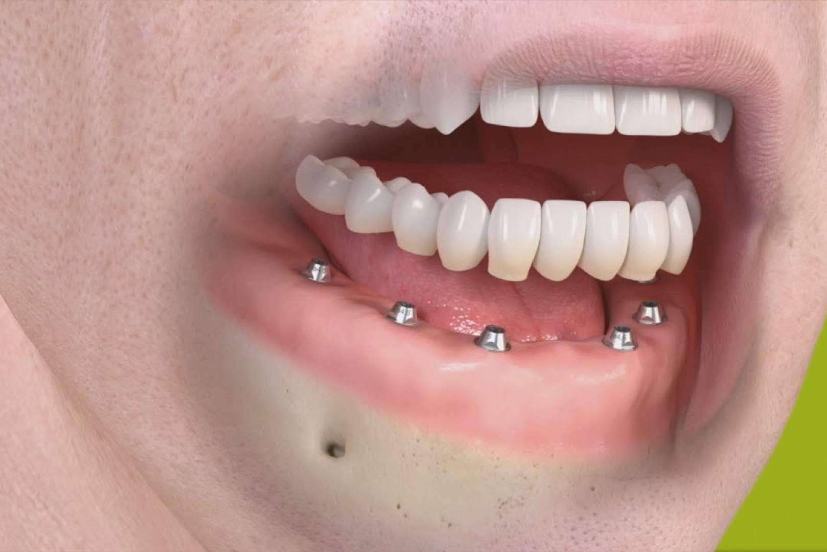 Rehabilitaciones orales complejas en un día en la clínica dental Bordonclinic