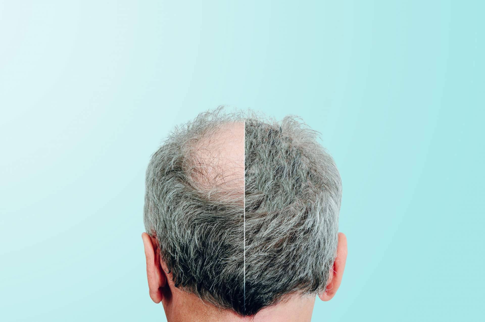 Nanofat, el tratamiento capilar de Clínica Tarrazo con el que es posible poner fin a la alopecia