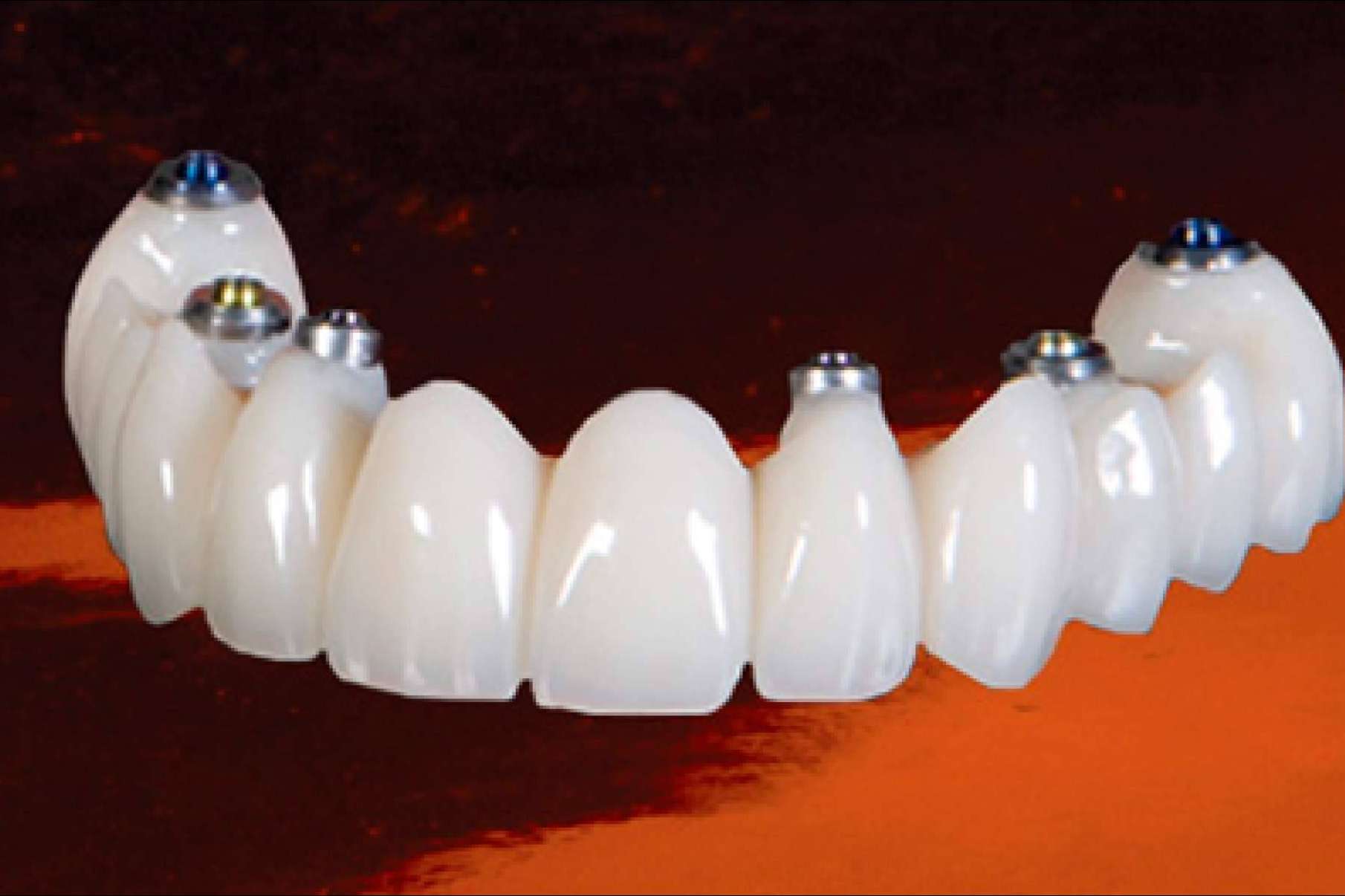 La clínica Dental Implantologie ofrece laboratorio propio para el servicio de estética dental y ortodoncia invisible