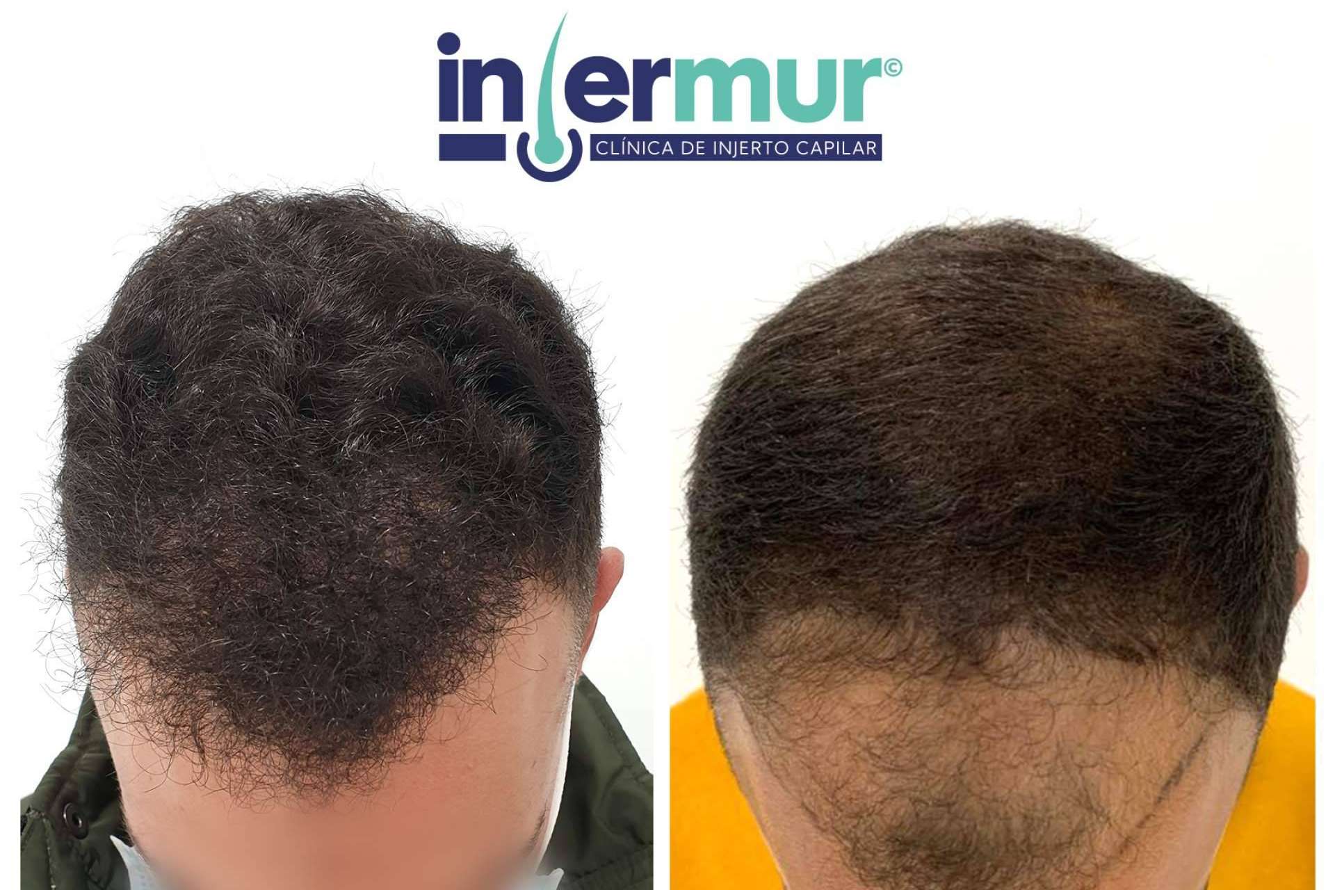 Combatir la alopecia androgénica de la mano de Injermur