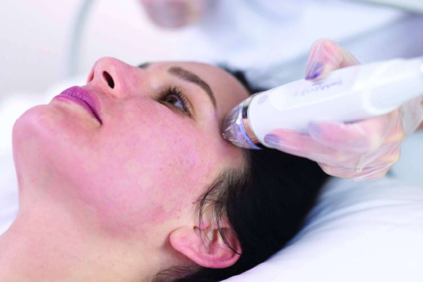 Alluring Clinic ofrece un tratamiento de radiofrecuencia fragmentada con microagujas