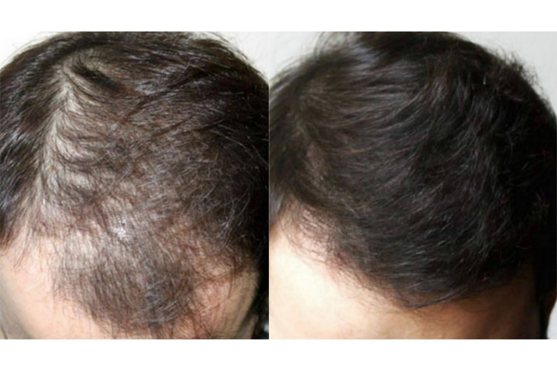 Tratamientos efectivos para alopecia androgenética, de la mano de Innovación Capilar