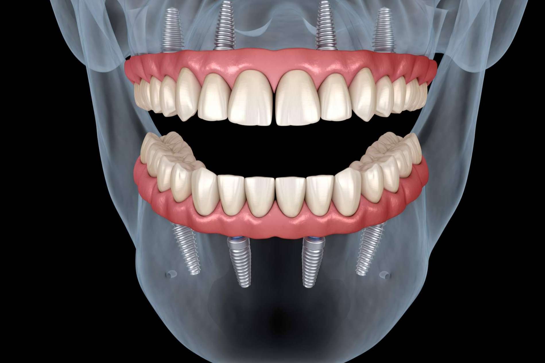 Precisión Médica Dental ofrece instrumentos para la confección adecuada de las prótesis dentales