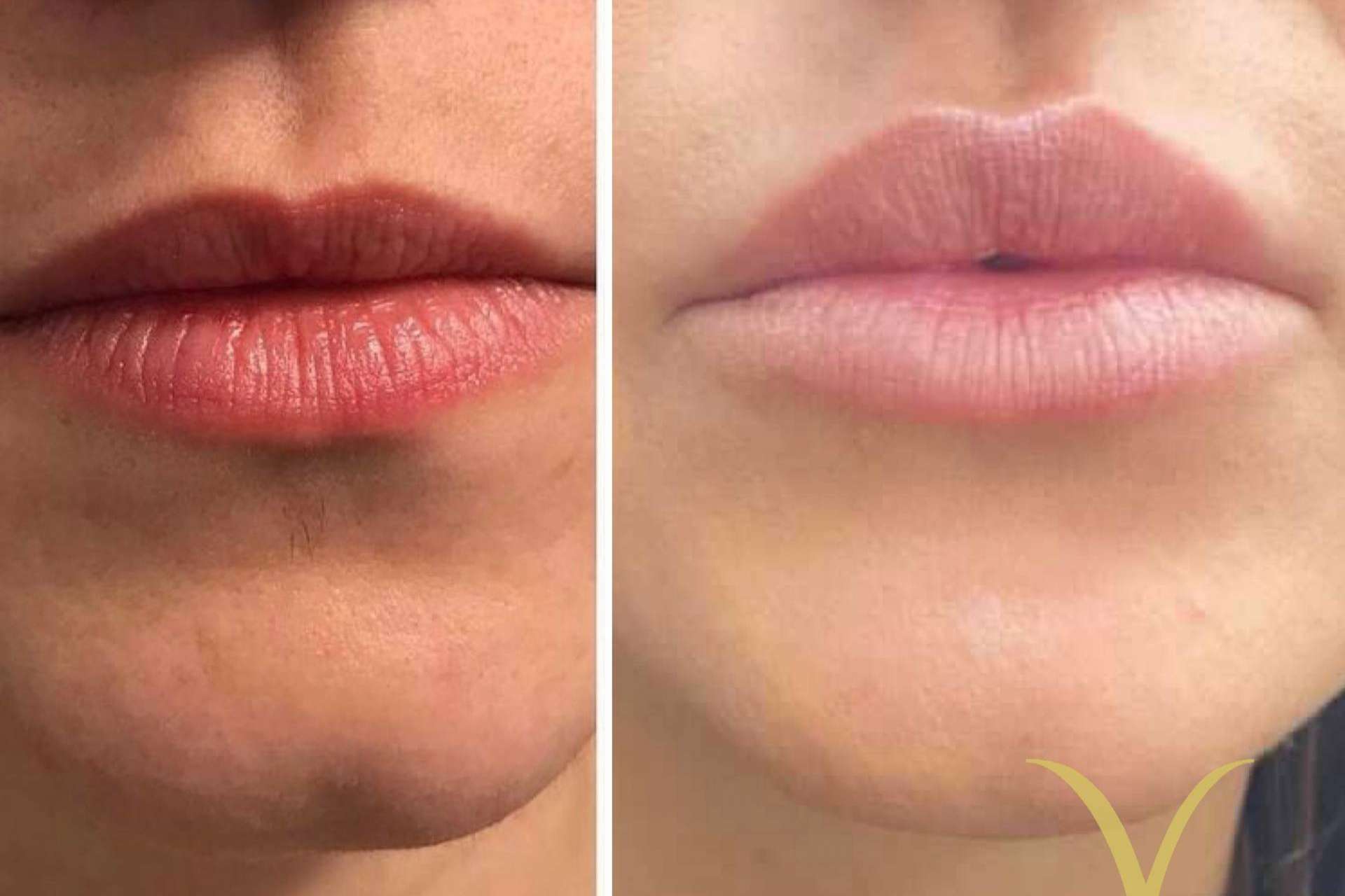El tratamiento de aumento de labios que ofrece la Clínica Yasmin