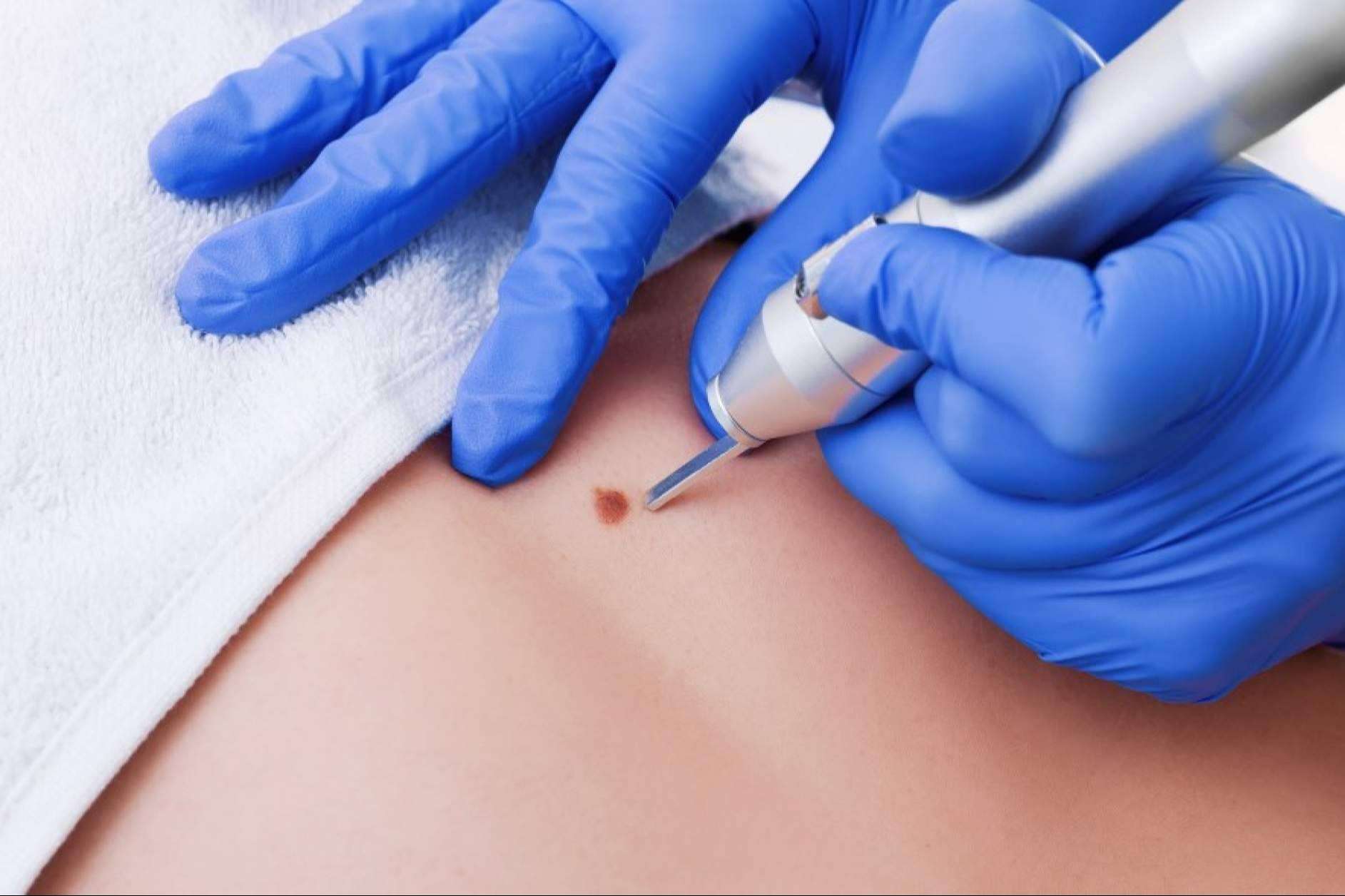 Tecnología de vanguardia para eliminar verrugas y lunares, en el Centro Médico El Pilar