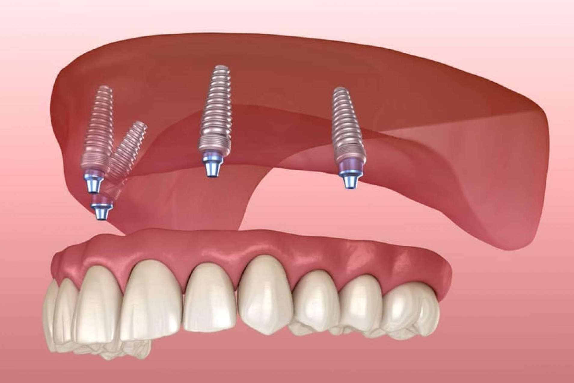 Los expertos de la Clínica Dental Crespí & Gandía ofrecen técnicas de rehabilitación oral para cada caso