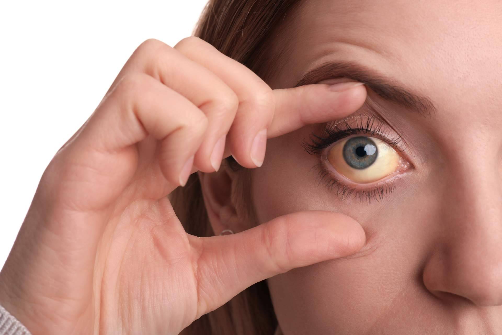 ¿Cuáles son las causas de los ojos amarillos y dónde tratarlos?, el Instituto Oftalmológico Dexeus lo explica