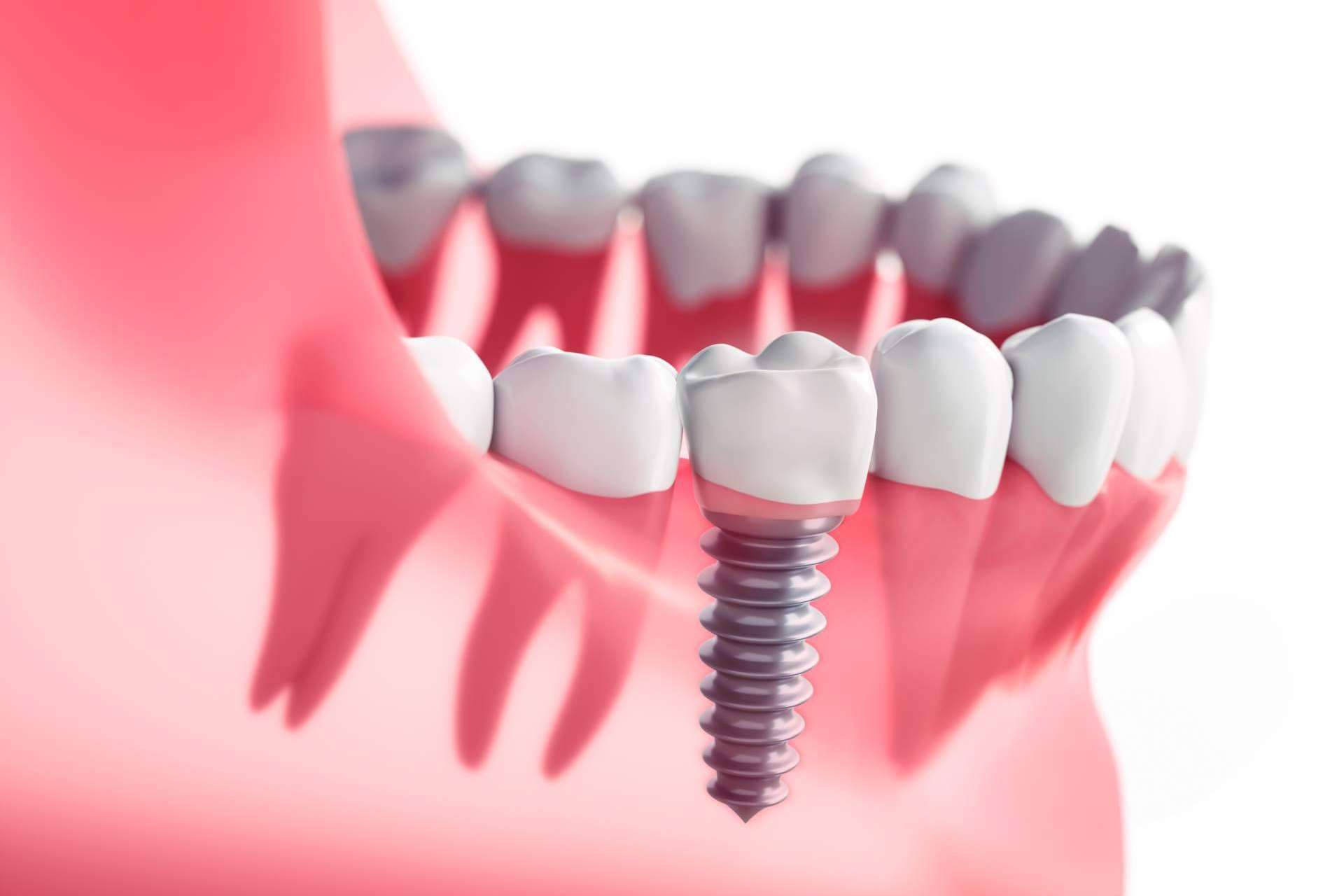 Los diferentes tipos de implantes dentales que existen y los que se deben escoger según las necesidades, por DeltaDent