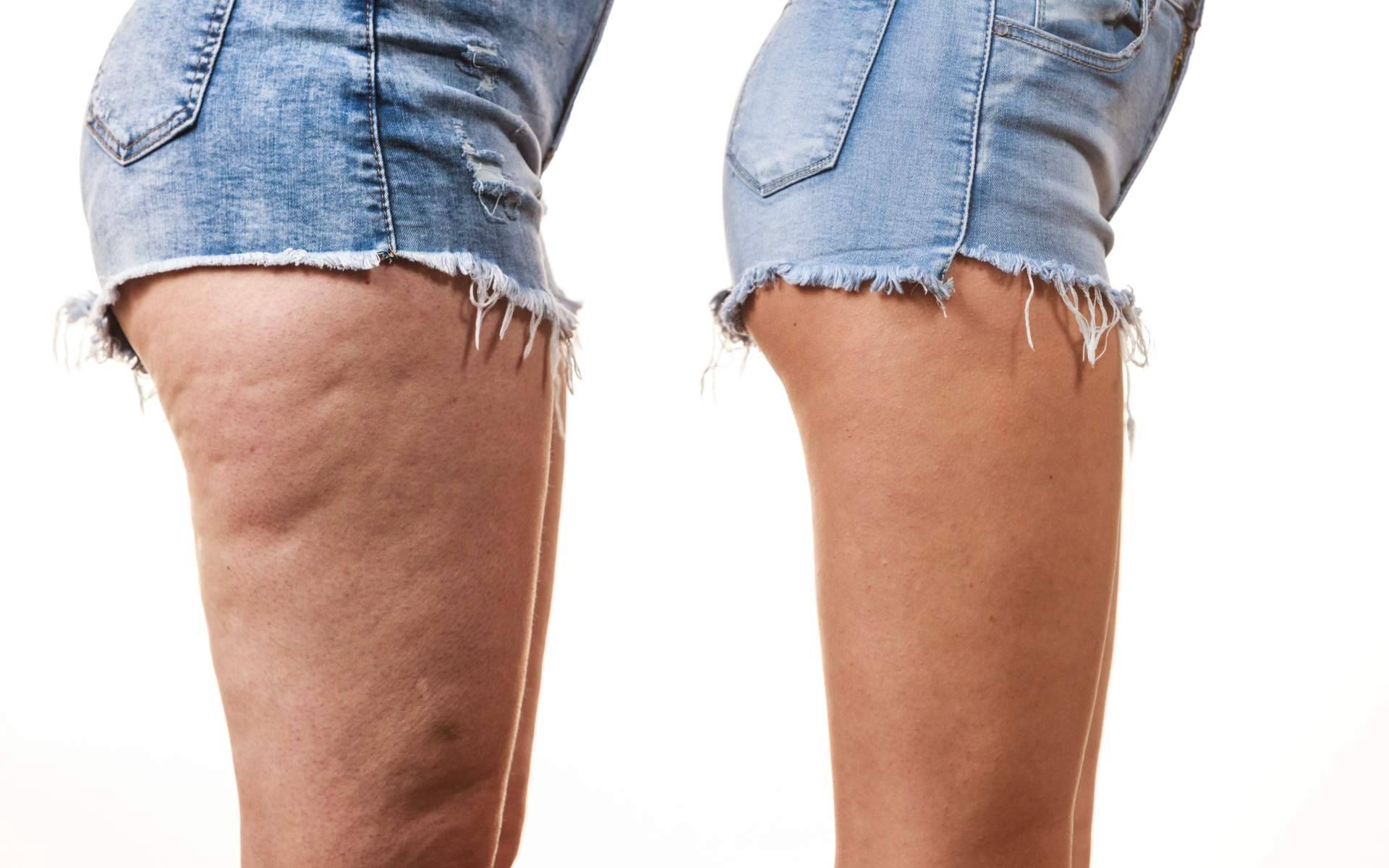 El tratamiento corporal para reducir la celulitis, Vacuslim 48, disponible en Mesmerie