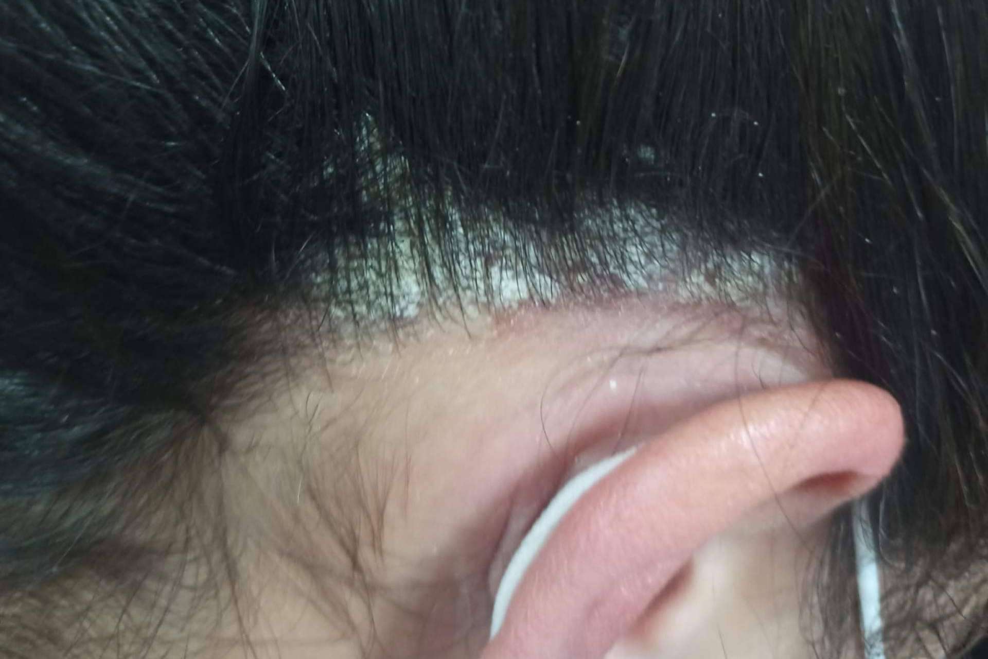 Nüwa trata los problemas de la piel mediante la acupuntura y la fototerapia