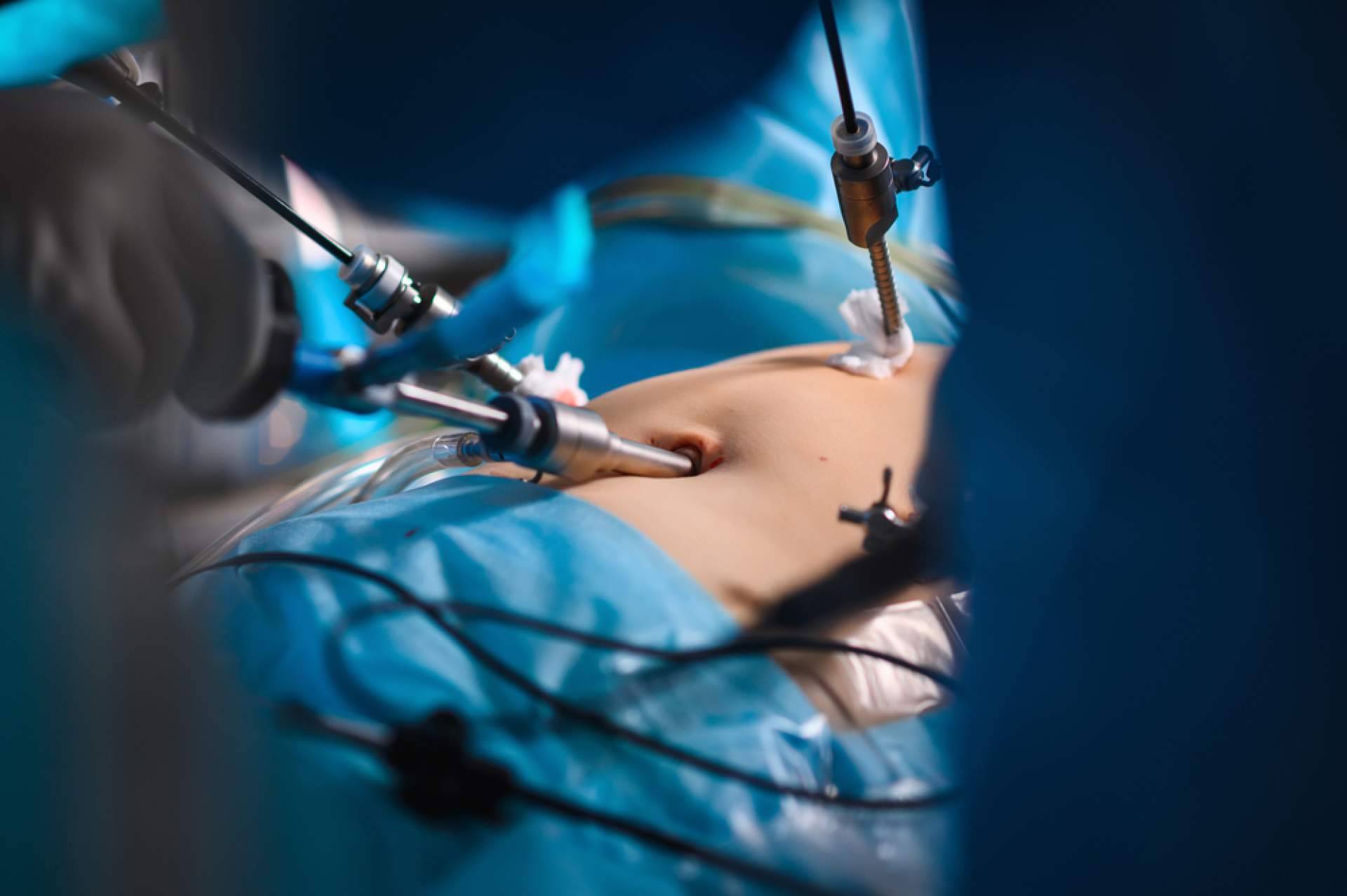 Resolviendo dudas sobre la cirugía de hernia inguinal, con el Dr. Javier Martínez Pascuas