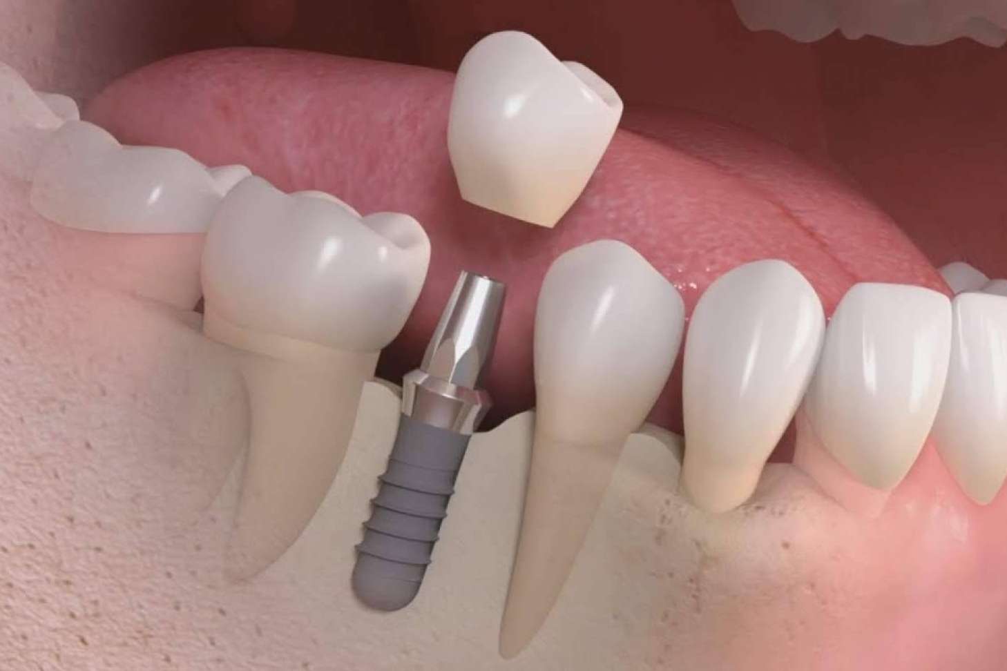 Todo sobre los implantes dentales de la Clínica Calvo de Mora