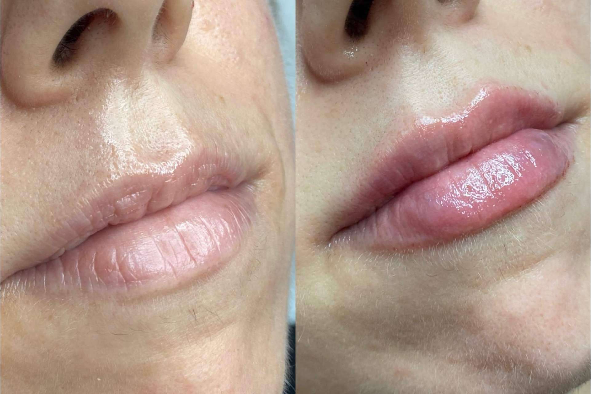La doctora Sandra Hermida explica en qué consiste su técnica de dos pasos para lograr unos labios 100 % naturales