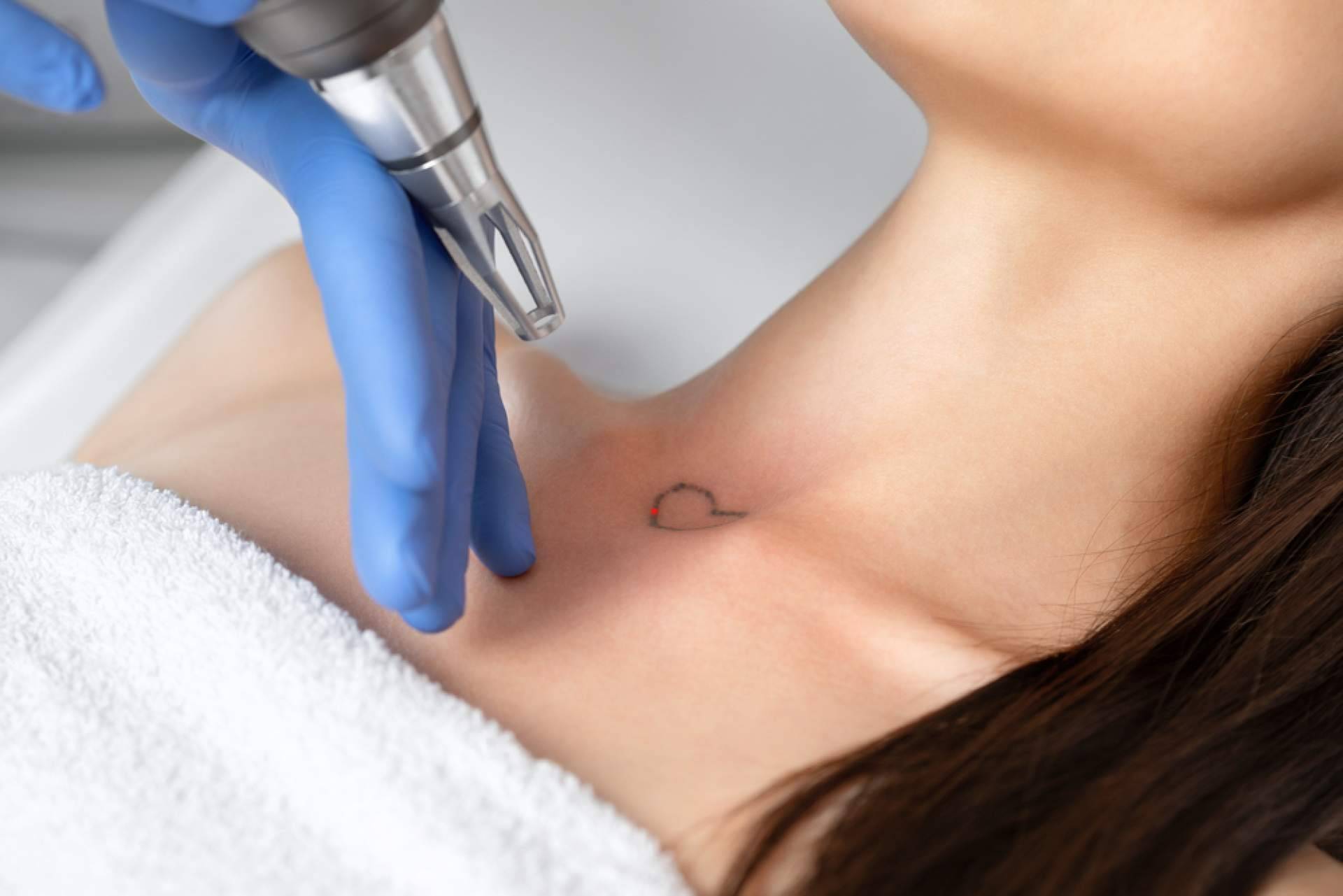 Eliminar tatuajes a color ya es posible de la mano de Ink Láser Alicante