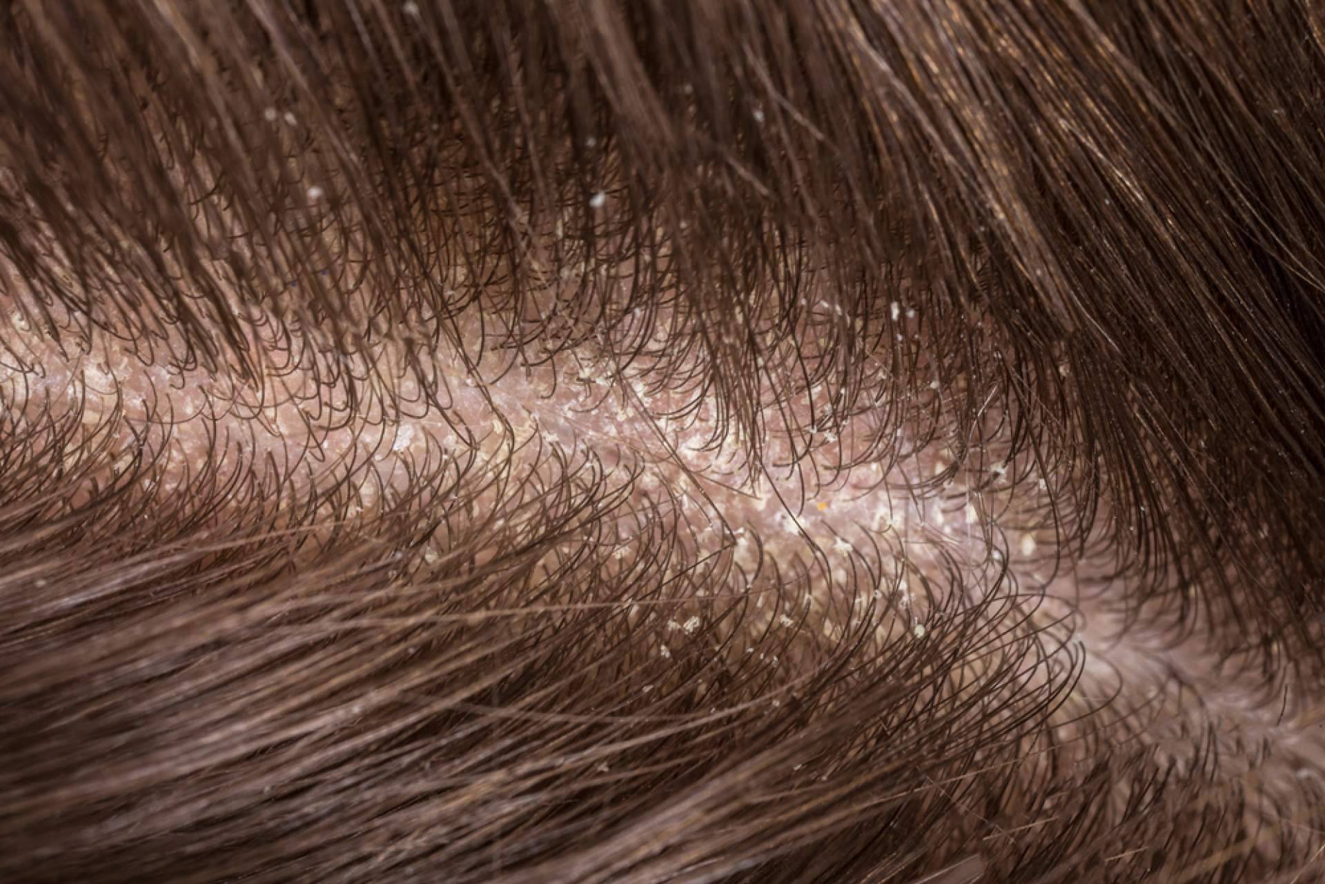 ¿Cuáles son los beneficios de realizarse un peeling capilar?, con Malecare