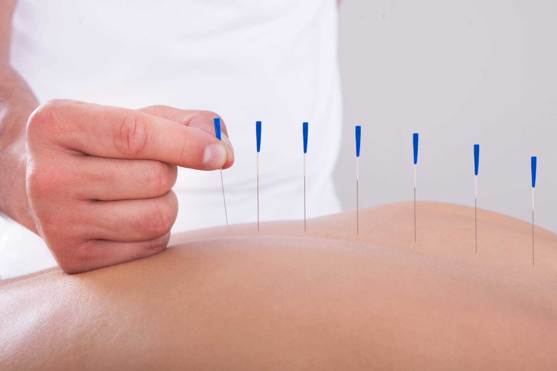La acupuntura tiene múltiples beneficios para la fertilidad, según Shenti Wellness