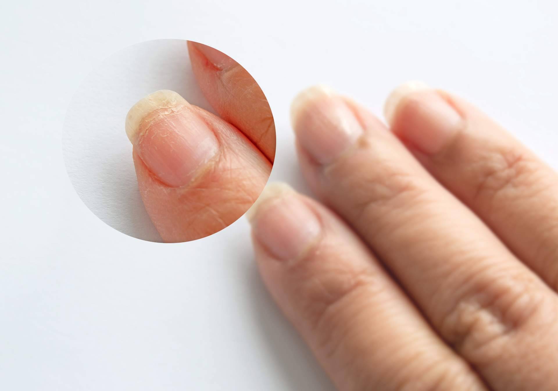El tratamiento holístico de uñas y cutículas, Lazonail®
