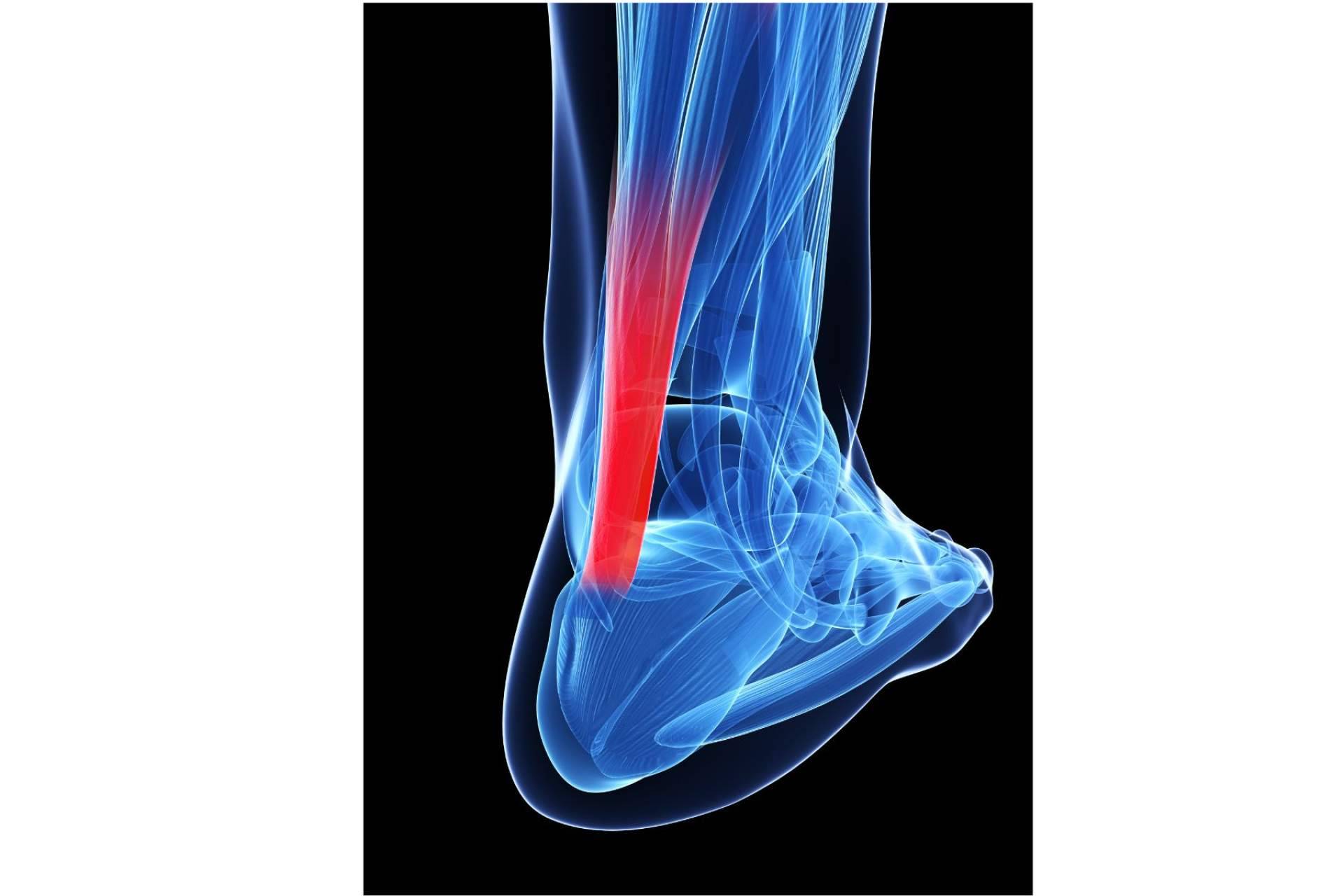 ¿Qué es y cómo mejorar la tendinitis con entrenamiento de fuerza?