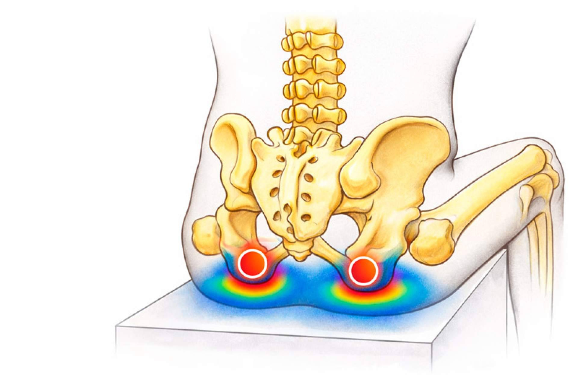 Cómo prevenir las úlceras por presión en personas que permanecen sentadas